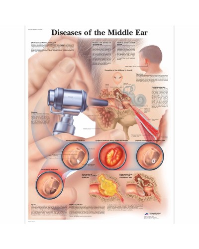 Diseases of the Middle Ear Chart